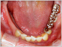 臼歯部症例術前