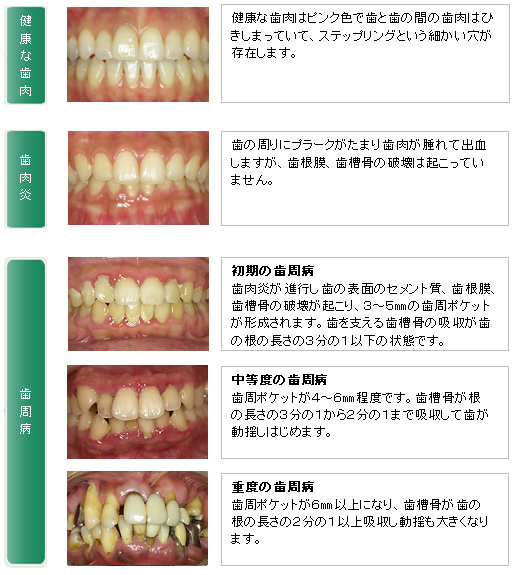 歯周病