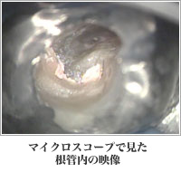 マイクロスコープで見た根管内の映像